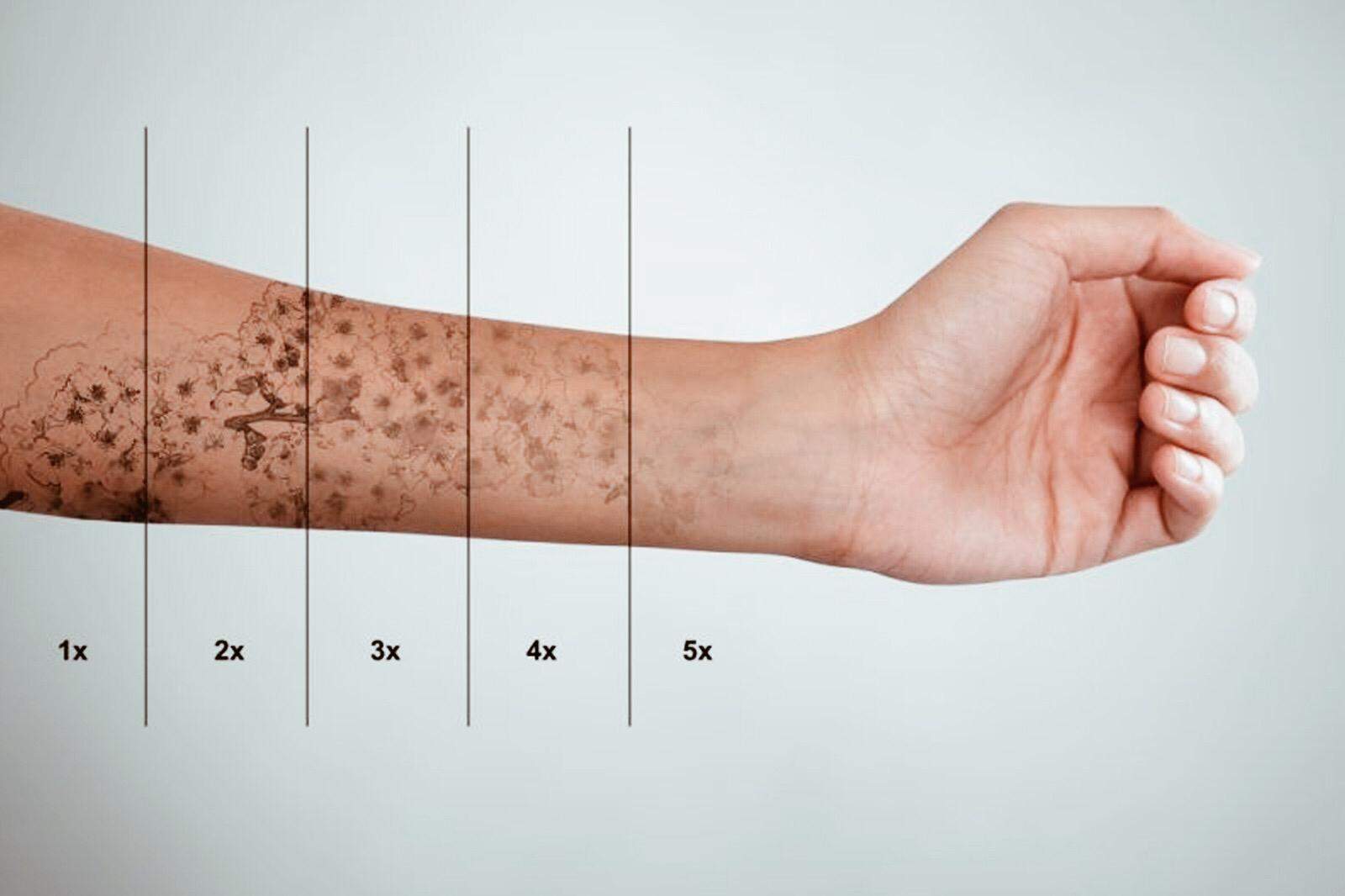 Eliminación de tattos en Alcalá de Henares